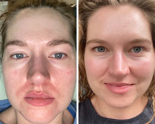 Side-by-side comparison of a person's face with redness and irritation on the left and clearer skin on the right.