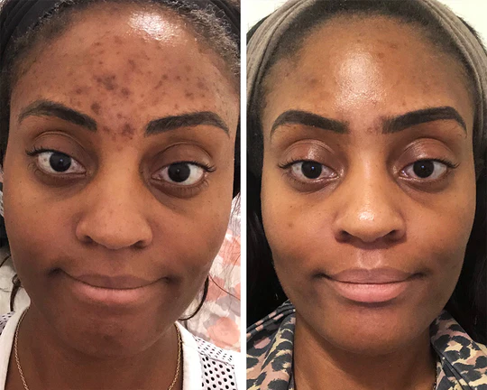 Side-by-side comparison of a woman's face showing acne and blemishes on the left and clear skin on the right.