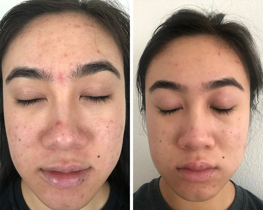 Close-up before-and-after images of a person's face, showing a reduction in acne and skin redness.