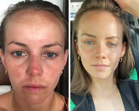 Side-by-side comparison of a woman’s face before and after skincare treatment, showing a visible improvement in skin texture and tone.
