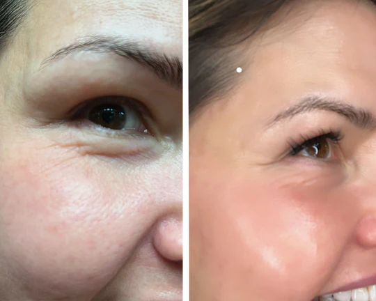 Close-up of a woman's face showing a before-and-after comparison of skin texture near the eye. The left side shows wrinkles, and the right side appears smoother.