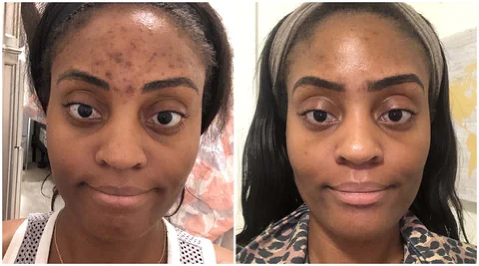 Two side-by-side photos show a woman before and after skincare treatment: left image with acne and blemishes, right image with clearer skin.