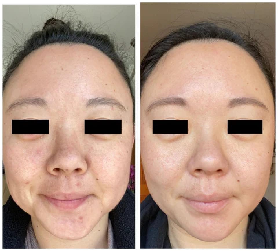 Side-by-side comparison of a woman's face before and after a skincare change, showing improvements in skin texture and tone, with eyes obscured for privacy.