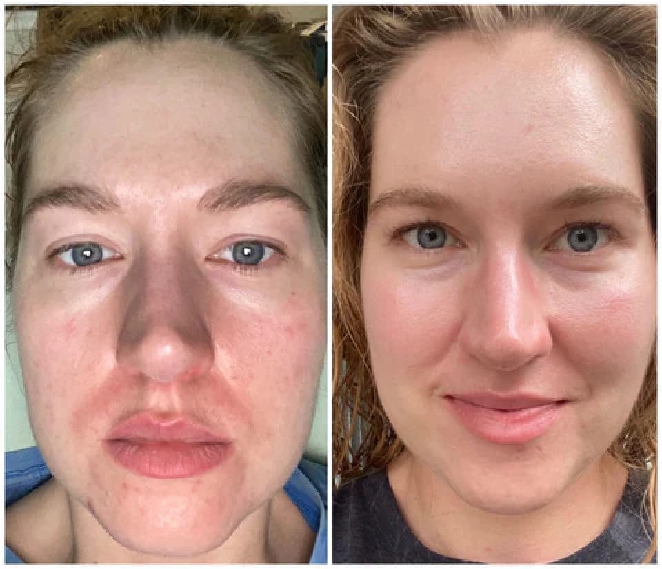 Close-up of a woman's face in a side-by-side comparison. Left: Redness and irritation visible. Right: Clearer, smoother skin with a slight smile.